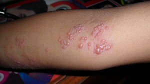 Illustration for article titled Obat Penyakit Herpes Ampuh Manjur